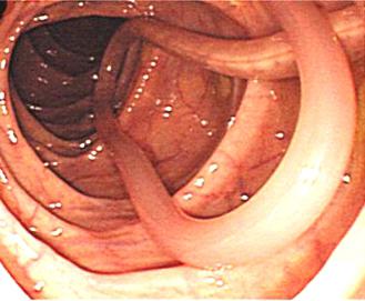 Enterobiasis fertőzés pinwormokkal - Bélféreg: okok, tünetek, kezelés - HáziPatika