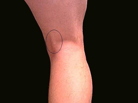 bolove u zglobovima prilikom čučnjeva akutna bol u mišićima i zglobovima nogu
