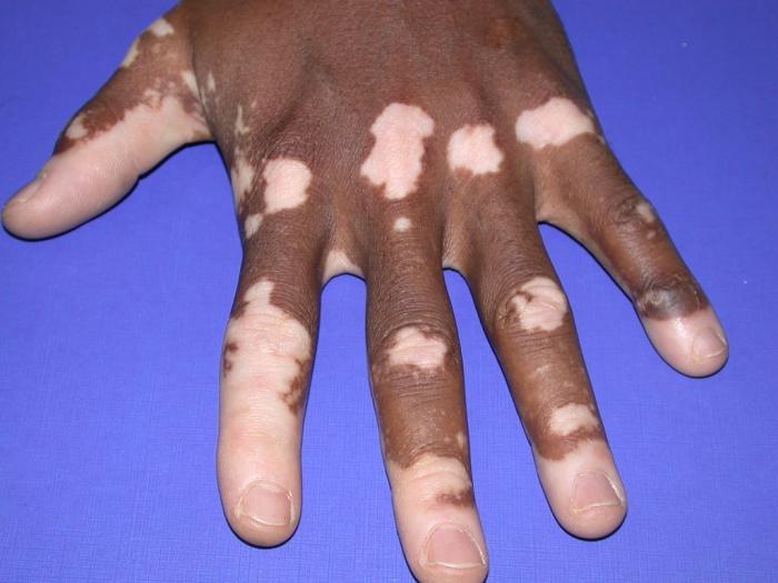 Vitiligo punca penyakit .: Sistem